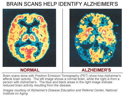 Image result for image of alzheimer's disease brain