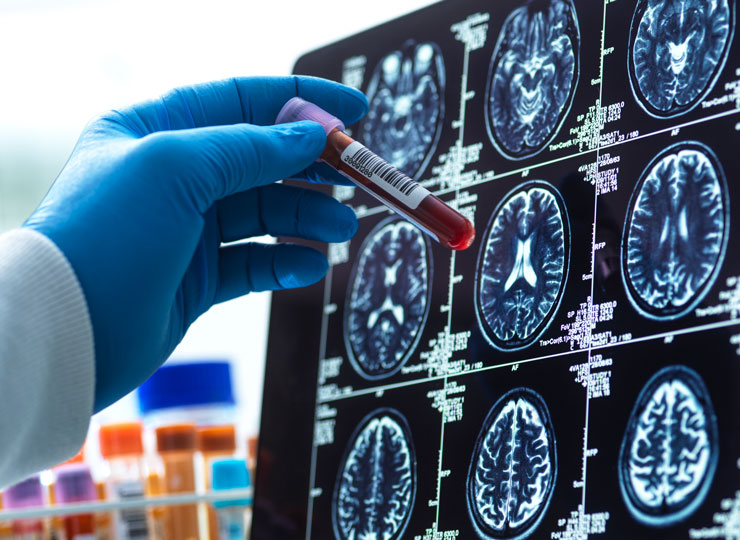 Clinician pointing to brain scans with blood samples in view